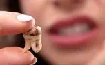 چرا دندان‌ها زود به زود پوسیده می‌شوند؟