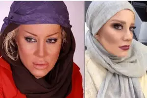 تزریق ژل لب بازیگری منو نابود کرد/ ویدئو