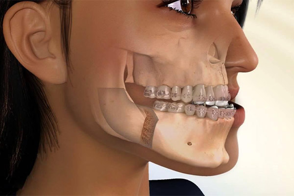 درمان آندربایت در بزرگسالان بدون جراحی
