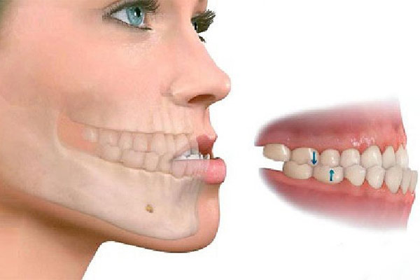 جراحی فک برای درمان آندربایت شدید