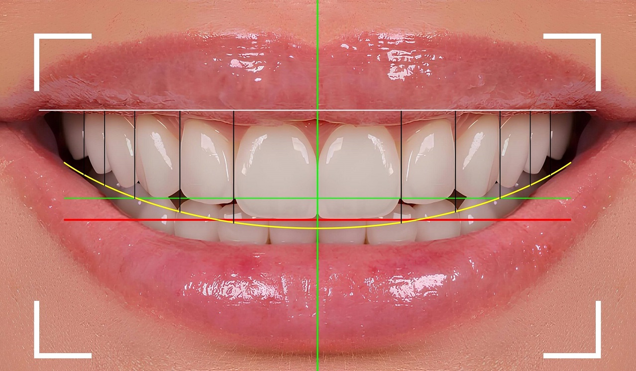 لمینت دندان چیست؟ بررسی کامل انواع، مزایا، معایب، مراحل و هزینه لمینت